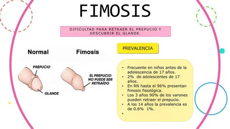 fimosis foto|Image: Fimosis